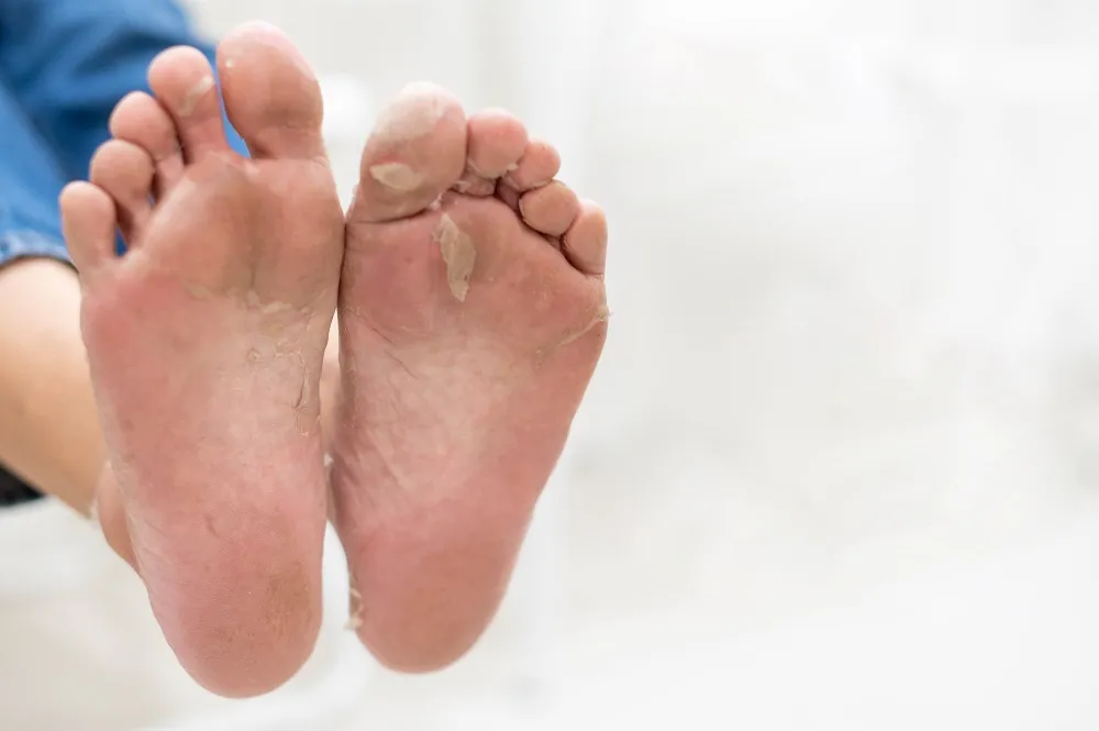 Tinea Pedis (Athlete's Foot) Fungal Infection Treatment