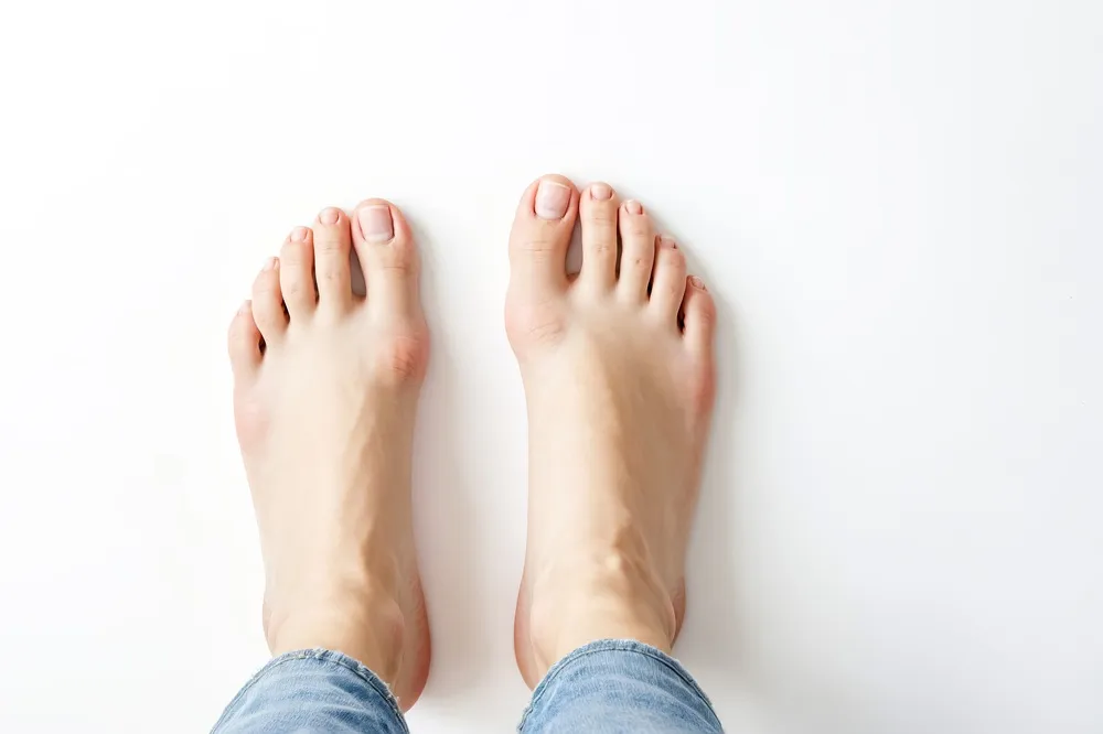 10 Powerful Insights About Bunion Surgery That Will Empower Your Decision (FAQ)