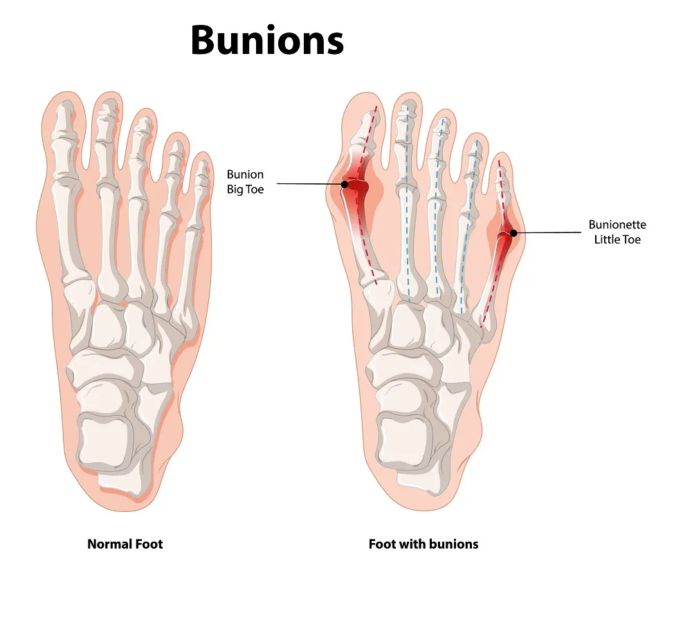Bunions: Causes, Symptoms, and Effective Treatment Options