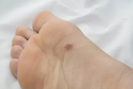 Diabetic foot ulcerations, We take them Seriously at WeTreatFeet Podiatry: Washington DC