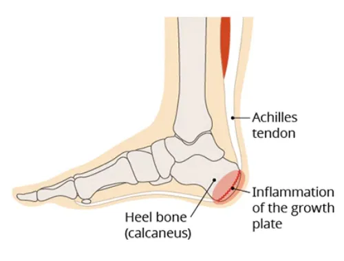 How Orthotics Can Alleviate Heel Pain: A Complete Guide