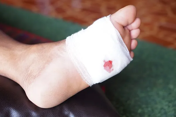 Wound Care, WeTreatFeet Podiatry Does That!